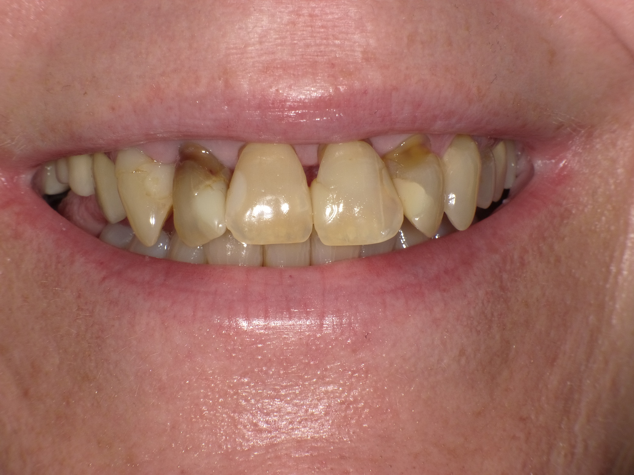 Angstpatientin mit unschönen Frontzähnen